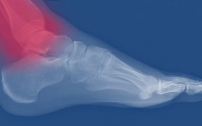 The Awful, Annoying Ankle Injury