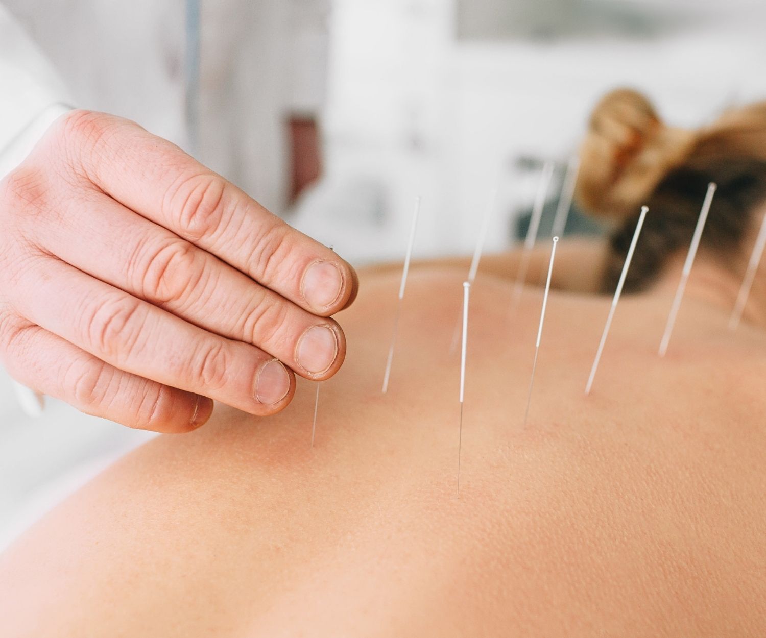 acupuncture - Active Health 